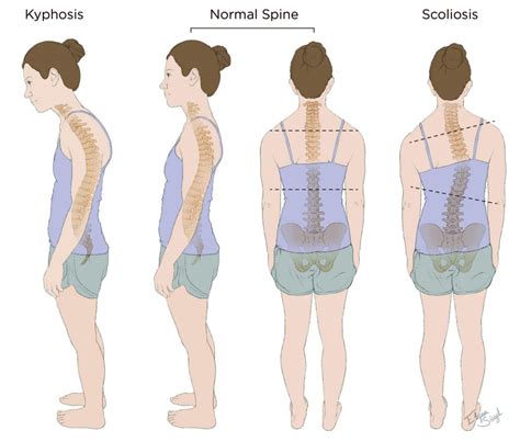 Spinal Deformity Types Diseases Of The Spine Scoliosi