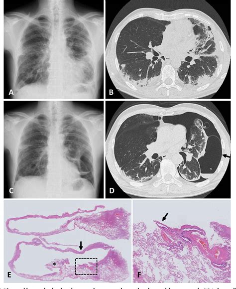 Figure 1 From Giant Bulla Formation In The Lung Because Of A Check