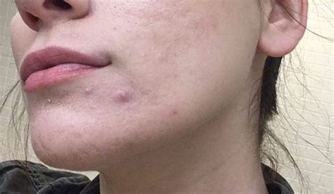 Quick And Effective Ways To Get Rid Of Chin Acne Wardrobe Cult