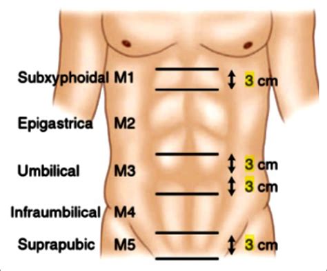 Classification Of Incisional Hernias According Tot The European Hernia