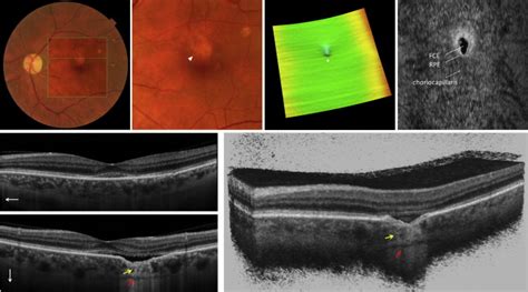 Focal Choroidal Excavation In Eyes With Central Serous