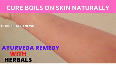 Cure Boils On Skin Naturallyayurveda Remedyhome Remedy In 2020
