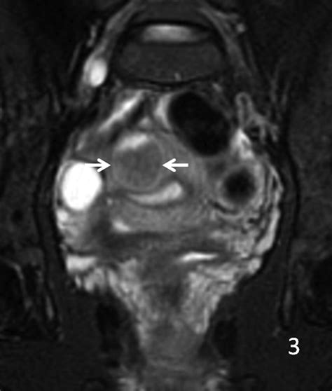 Diagnosis And Management Of An Adenomatoid Uterine Tu Vrogue Co