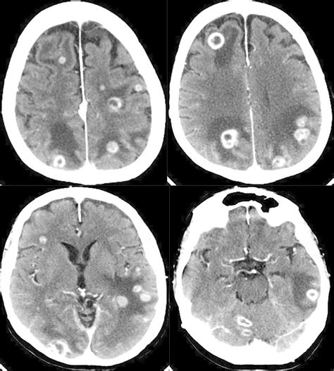 Disseminated Nocardiosis With Cerebral And Subcutaneous Lesions On Low
