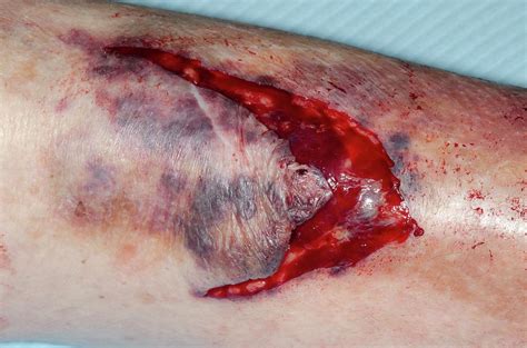 Laceration Of Shin From A Fall Photograph by Dr P. Marazzi/science ...