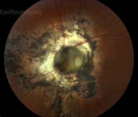 Atlas Entry Optic Nerve Coloboma With Staphyloma