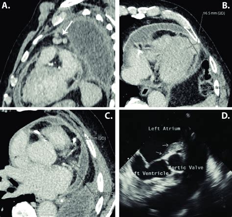 A Enlarged Periaortic Lymph Nodes B C Metastases To Myocardium And