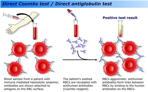 Antibody Screening And The Coombs Test Urine Or Urout