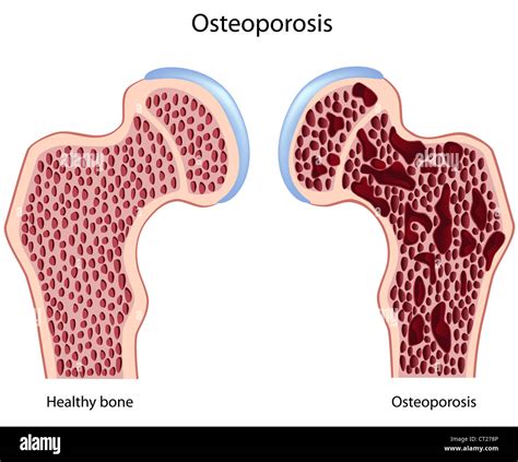 Osteoporosis Of Femur Hip Bone Stock Photo Alamy