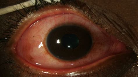 Epidemic Keratoconjunctivitis Eyewiki