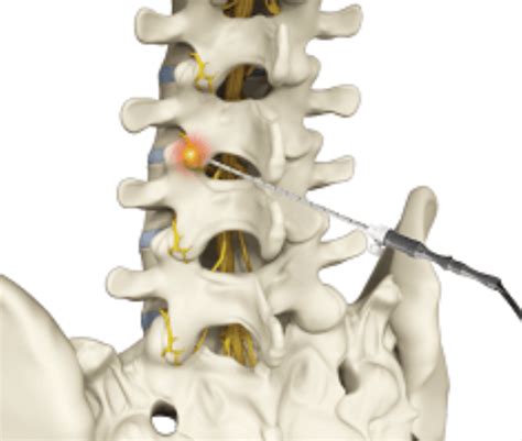 Lumbar Radiofrequency Ablation Rfa Omaha Pain Physicians