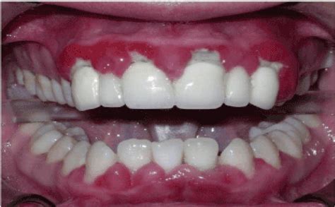 Review Differential Diagnosis Of Drug Induced Gingival Hyperplasia And