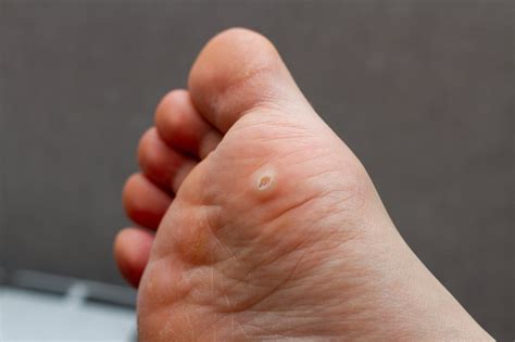 What You Should Know About Plantar Warts — River Podiatry I The Best