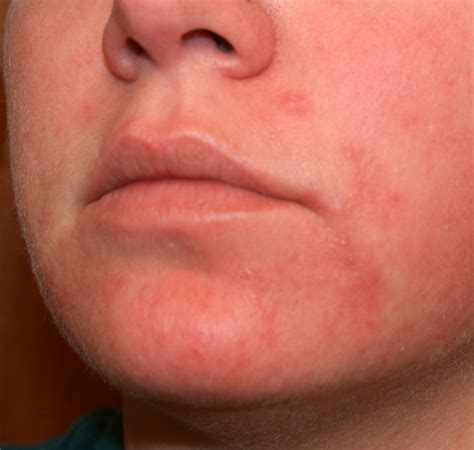Small Rash On Face Pictures Photos