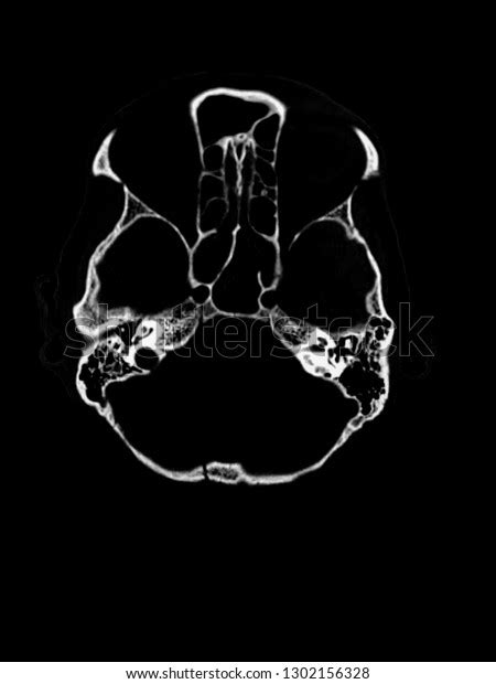 Ct Scan Skull Fracture Occipital Bone库存照片1302156328 Shutterstock