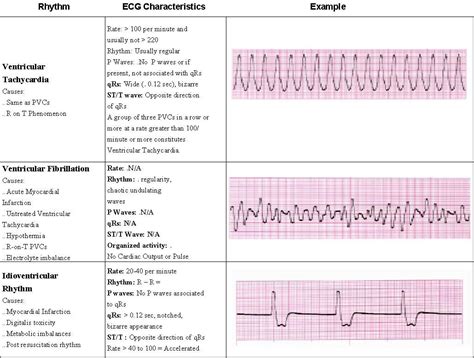 Identify the following rhythm a. Pin by Saving American Hearts, Inc. on Saving American ...