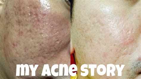 My Acne Story Fractional Co2 And Derma Roller Acne Scars Youtube