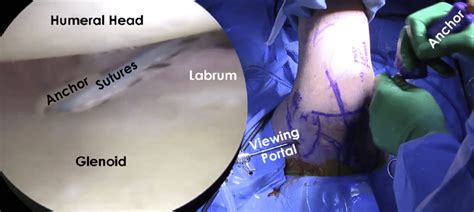 7 draw labelled diagram showing the relations of shoulder joint. A view of the posterior labrum and capsule of the right ...
