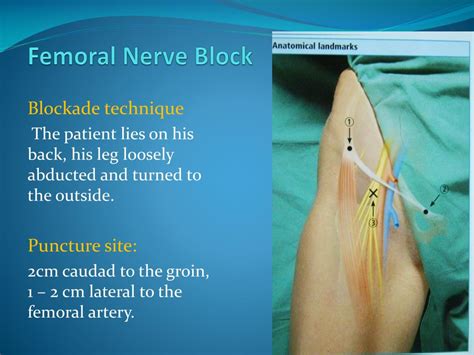 Femoral Nerve Block Technique