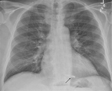 Leadless Pacemaker Chest X Ray