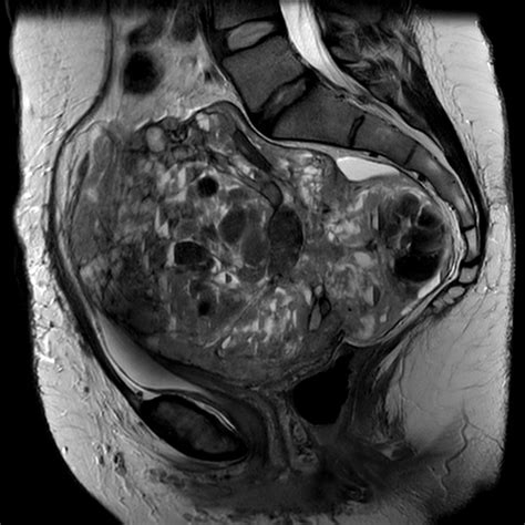 Leiomyosarcoma Of The Uterus Image