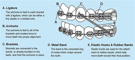 Braces Diagram And Parts Orthodontist South Plainfield Nj