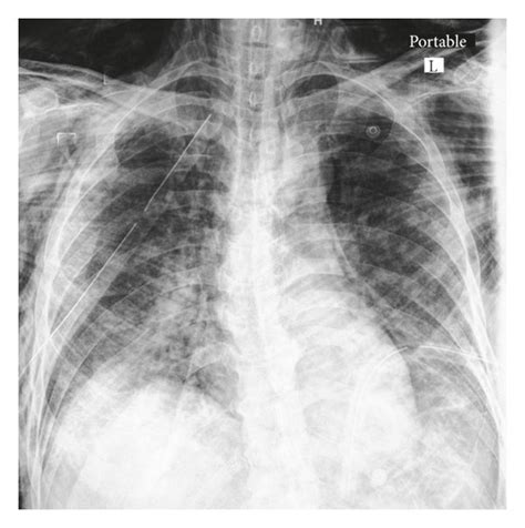 Chest X Ray Showing Pneumomediastinum And Subcutaneous Emphysema With Download Scientific