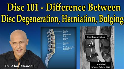 DISC The Difference Between Disc Degeneration Herniation Bulging Dr Mandell YouTube