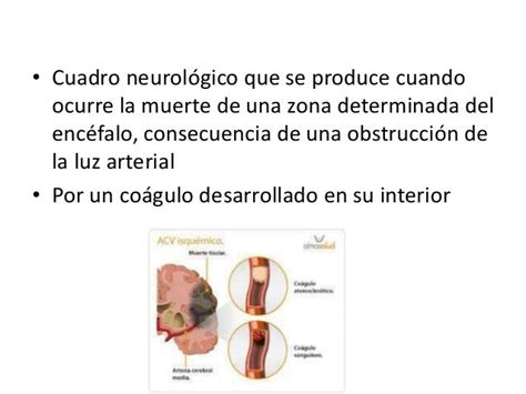 Trombosis Cerebral Neurología