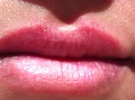 my upper lip..very small red rash & swelling..psoriasis..lip balm..Lip