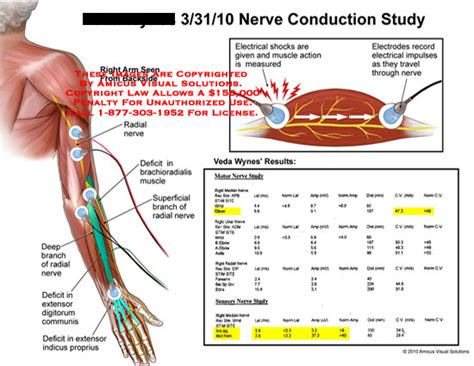 Nerve Conduction Study