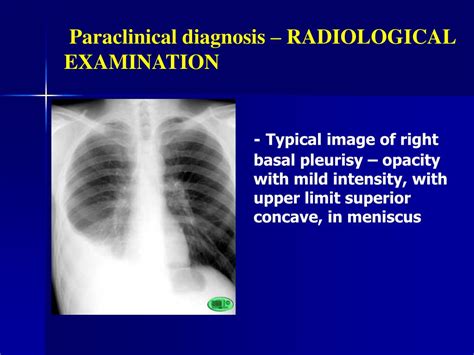 Ppt Diagnosis Of Tuberculous Pleurisy Powerpoint Presentation Free