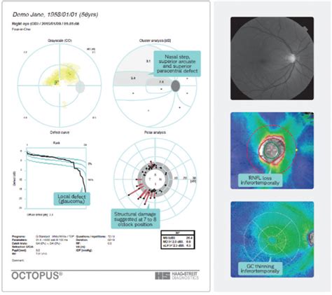 Structure And Function In Early Glaucoma Diagnosis Modern Optometry