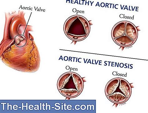 Aortic Valve Stenosis 💊 Scientific Practical Medical Journal 2023