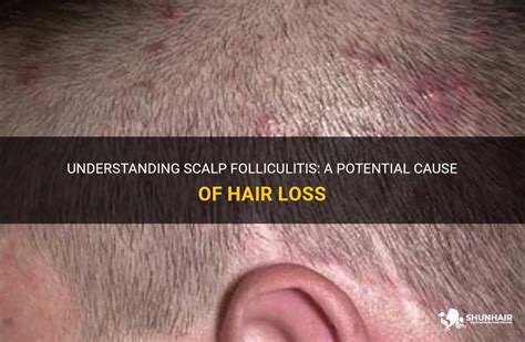 Understanding Scalp Folliculitis A Potential Cause Of Hair Loss Shunhair