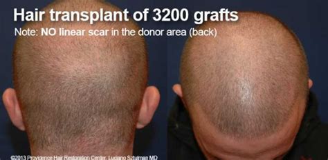 Hair Transplant Before After Photos Providence Hair Restoration