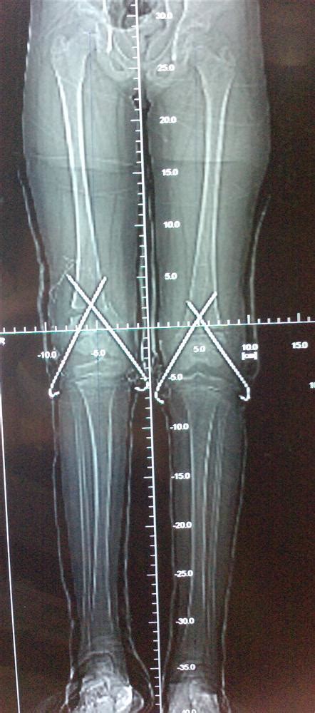Genu Valgum Knocked Knees Pediatrics Orthobullets