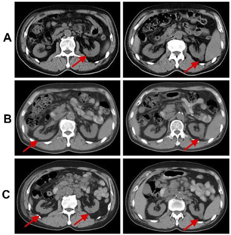 Abdominal Ct Scans Showing Dynamic Changes In Renal Cysts A Before