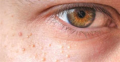 Milialar A Skin Disease Everything You Need To Know For Upon