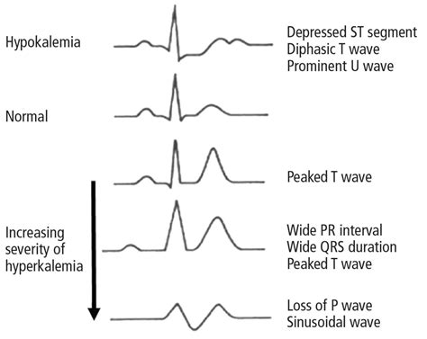 Diagnosis And Treatment Of Hyperkalemia Cleveland Clinic Journal Of