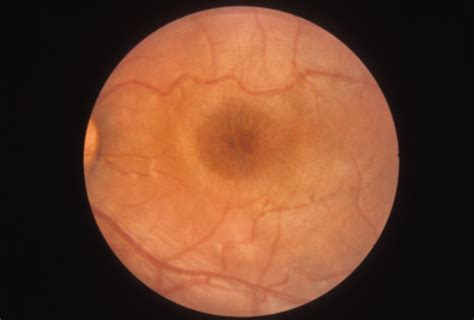 Retinoschisis Juvenile Hereditary Ocular Diseases