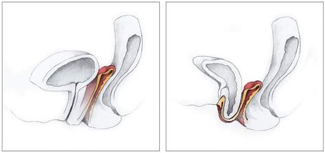 Two Surgeries For Pelvic Prolapse Found Similarly Effective Safe