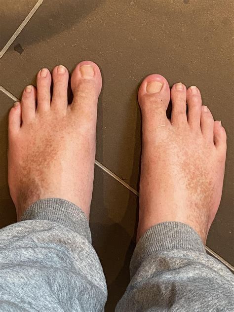 I Developed These Frecklesspots On My Feet Last Summer Is That Normal