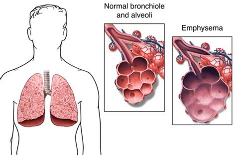 Emphysema Symptoms Causes Treatment Pictures Definition