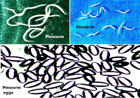 Pinworm Infections Signs And Symptoms Causes Diagnosis And Treatment