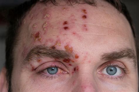 What Does Shingles On The Eyelid Look Like