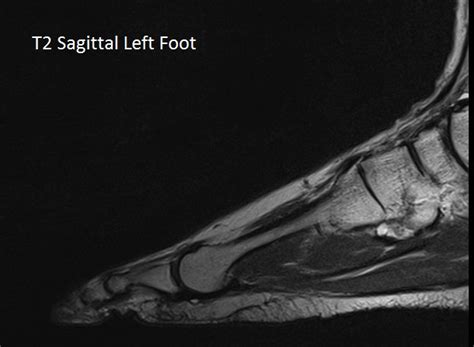 Mri with hardware in foot? MRI Scan Images | Worcestershire Imaging Centre