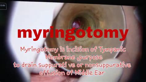 Endoscopic Myringotomy Grommet Insertion Using Needle Dr Sultan