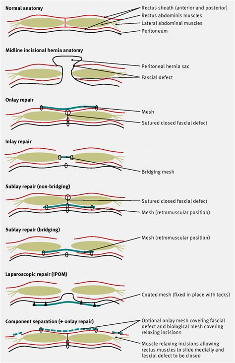 The Modern Management Of Incisional Hernias The Bmj