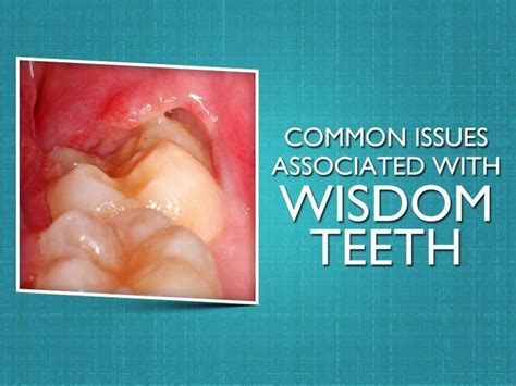 Wacky Tooth Decay Study Teethwhiteningatl Dentalofficerenovation